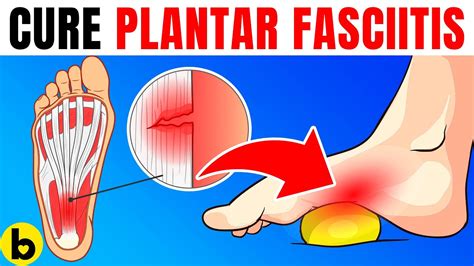 10 Proven Tips For Immediate Relief From Plantar Fasciitis Youtube