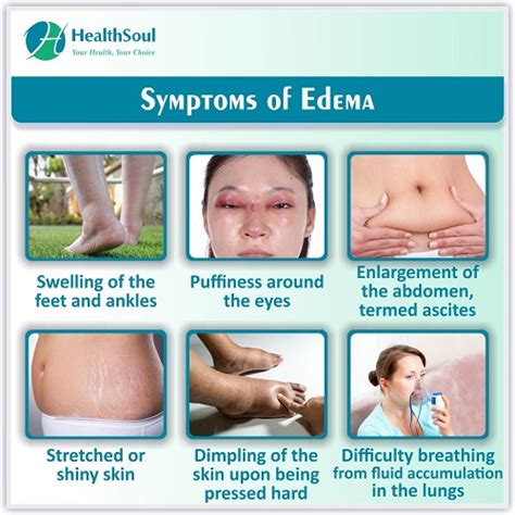 Edema Cause Symptoms And Treatment Healthsoul