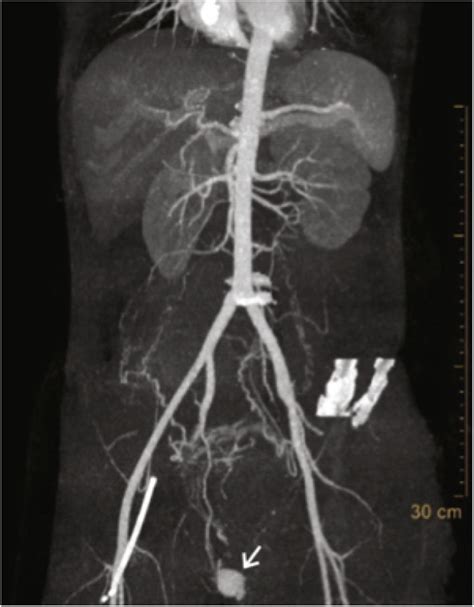 Initial Ct Angiography Demonstrating Active Extravasation Of Contrast