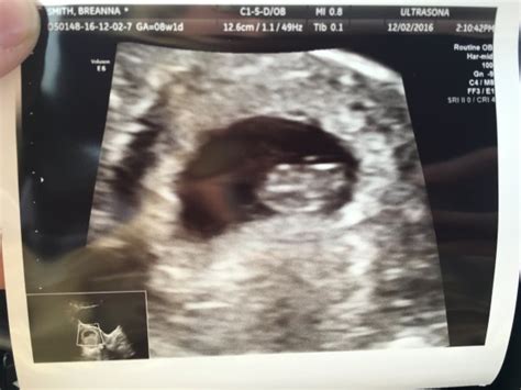 Anyone Else Think This Ultrasound Looks Weird 8 Weeks Babycenter