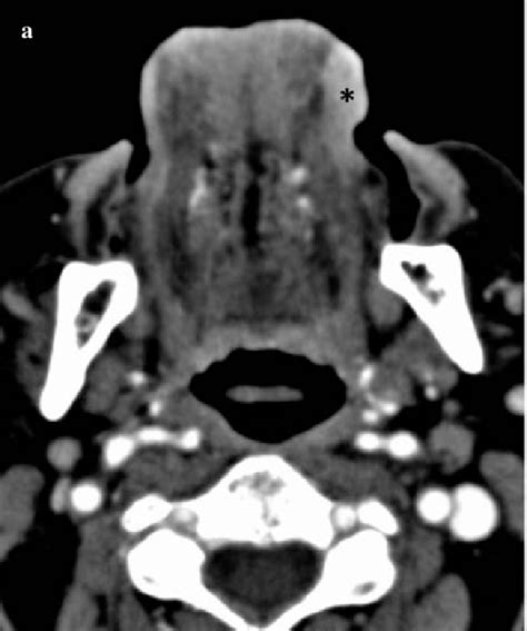 Ab Axial Contrast Enhanced Computed Tomography Image Obtained With