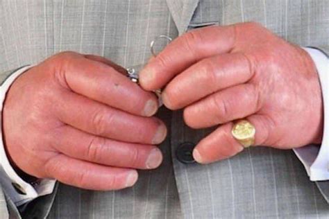 Prince Charles Finger Condition Explored As Pictures Of Swollen Hands
