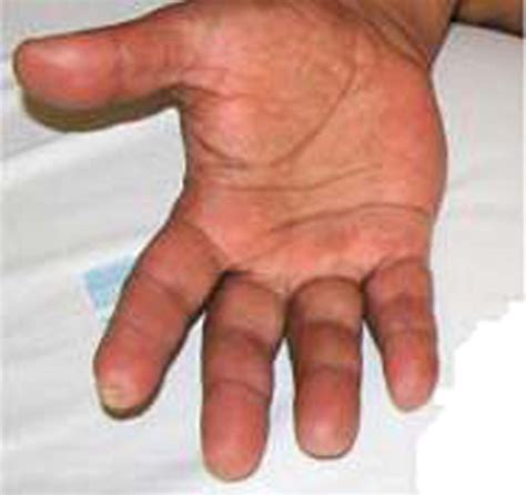 Buerger’s disease (Thromboangiitis obliterans): a diagnostic challenge