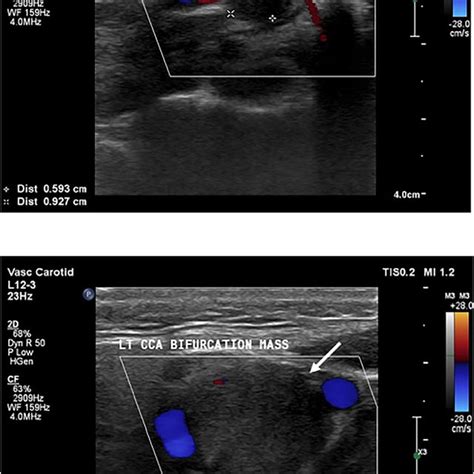 A And B Ultrasound Shows Solid Well Defined Hypoechoic Mass Located