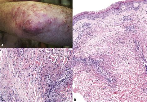 Palisaded Neutrophilic Granulomatous Dermatitis Without A Definable