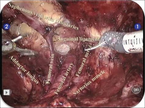 Robotic Assisted Inguinal Lymph Node Dissection A Preliminary Report