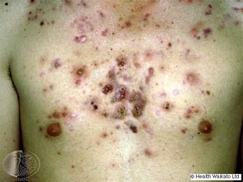 Types Of Acne With Pictures Mild Moderate Severe Ehealthstar