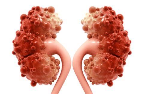Polycystic Kidney Disease Symptoms Causes And Complications Factdr