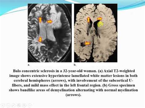 White matter diseases are heterogeneous conditions linked together because they involve the same real estate. white matter disease with radiologic pathologic ...