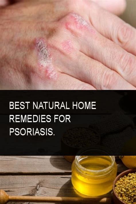 Psoriasis On Face Home Treatment