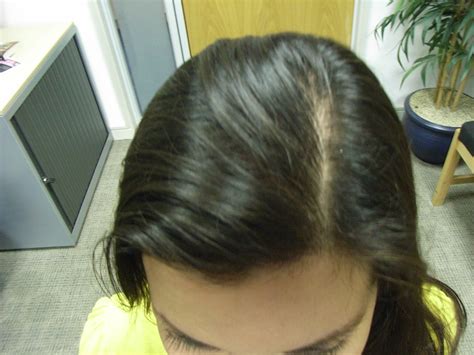 The Hair Loss Centre FEMALE HAIR LOSS PHOTOS TREATED
