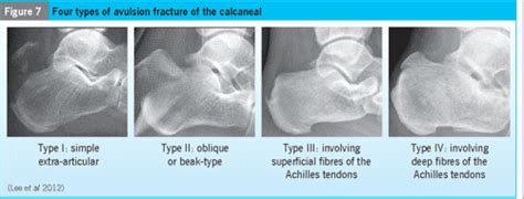 Avulsion Fracture Of The Calcaneal Tuberosity Diagnosis And Treatment