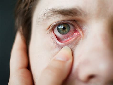Eye Allergies Demystified Anaheim Eye Institute
