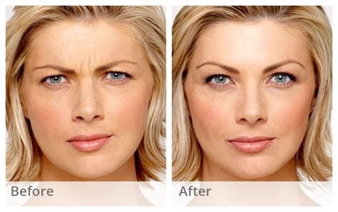 Botox Before And After Photos The Laser Image Company