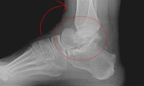 Dr K Lam Straight Talk Talus Fracture Personal Injuries Pi Common