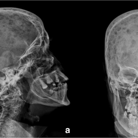 Skull Radiographs On Lateral A And Frontal B Projection Showing The