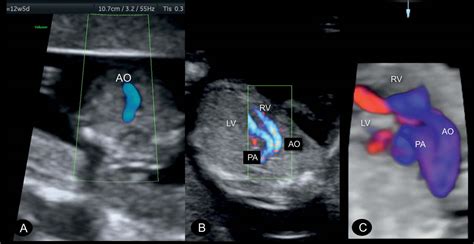 Transposition Of The Great Arteries Fetal Ultrasound