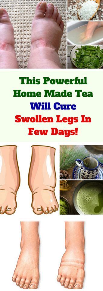 Have You Ever Experienced Swelling In The Legs Hands Or Feet If You