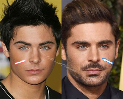 Zac efron has never admitted to having a nose job. Zac Efron, Before and After - Celebrity Plastic Surgery