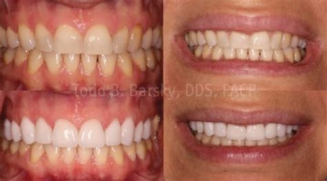 Cosmetic Dentistry And Complete Smile Makeovers In Miami Barsky Dds