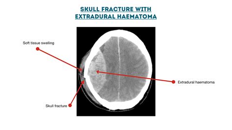 Extradural Haematoma Showing Fracture Geeky Medics