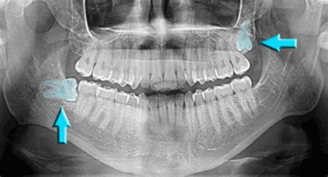 Wisdom Teeth Extraction From Willow Dental Care