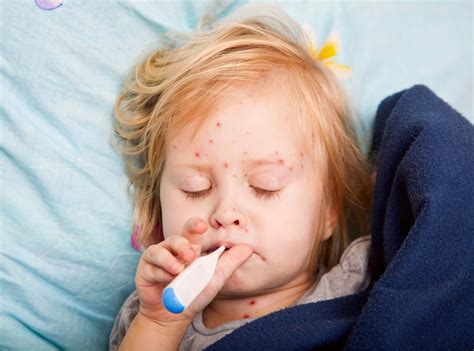 Παγκόσμιος συναγερμός για την ιλαρά Η πανδημία άφησε ανεμβολίαστα εκατομμύρια μωρά