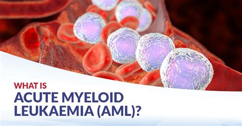 Acute Myeloid Leukaemia Aml Signs And Treatments