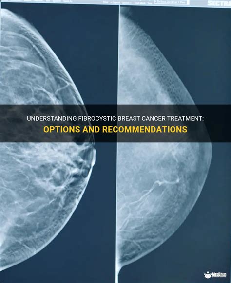 Understanding Fibrocystic Breast Cancer Treatment Options And