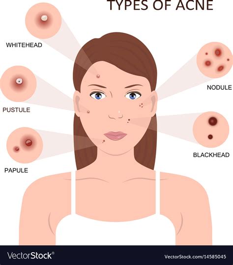 Types Of Acne Woman With Pimples Royalty Free Vector Image