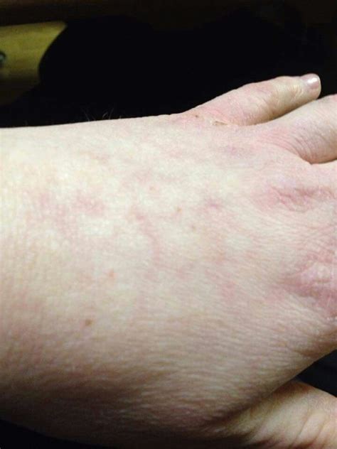 Livedo Reticularis Vasculitis Condition Of Blood Not Flowing Well
