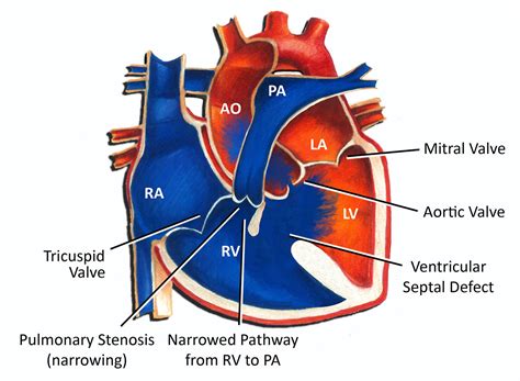 Tetralogy Of Fallot Pediatric Heart Specialists