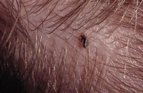 A Step By Step Guide To Naturally Getting Rid Of Lice At Home Remedygrove