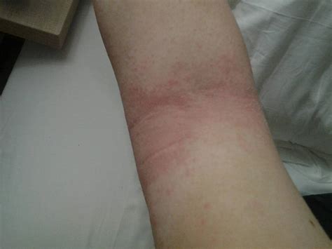 Help With Eczema