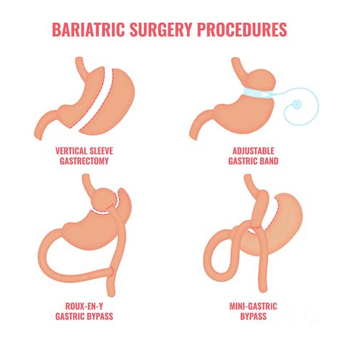 Bariatric Surgery Types Photograph By Art Stock Science Photo Library Pixels