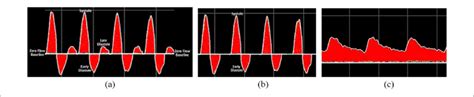 A Triphasic B Biphasic And C Monophasic Doppler Waveforms