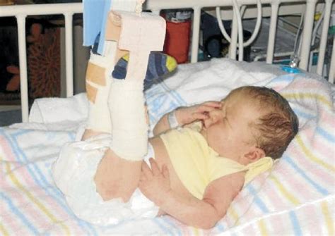 Newborn Babys Broken Leg Goes Undetected Illawarra Mercury