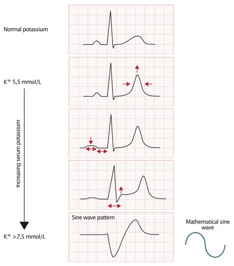 Ecg Changes Due To Electrolyte Imbalance Disorder Ecg And Echo