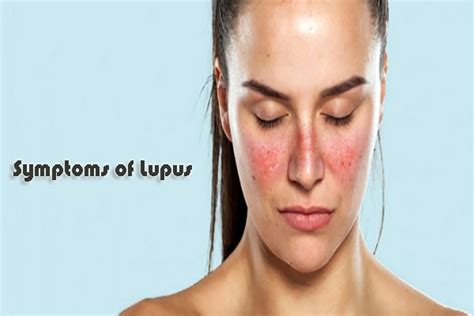 What Is Lupus Symptoms Causes Treatment And Prevention How To Relief