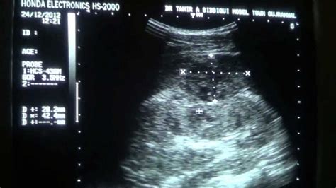 Perirenal Abscess In Kidney With Focal Pyelonephritis Youtube
