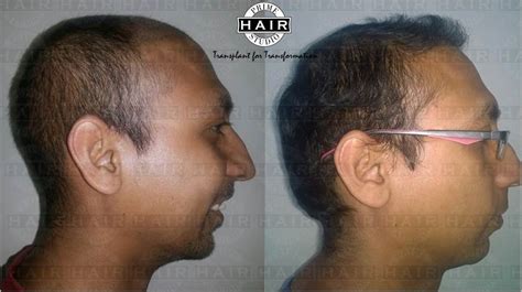 Cost Of Hair Transplant In Mumbai India Prime Hair Studio