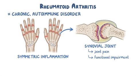 Rheumatoid Arthritis Clinical Sciences Osmosis Video Library