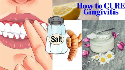How To Cure Gingivitis With Turmeric Coconut Oil Baking Soda Or