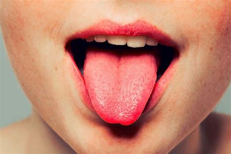 How To Get Rid Of Lie Bumps On Your Tongue Natural Ways Lie