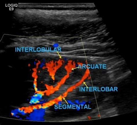 Renal Transplant Duplex Protocol Sonographic Tendencies