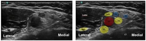 Ultrasound Guided Axillary Brachial Plexus Block Wfsa Resources