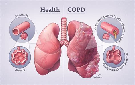 Copd Symptoms Causes And Treatment You Should Know