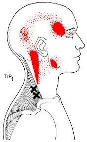 How to address your cervicogenic headache. Treating Cervicogenic Headaches with Physiotherapy ...