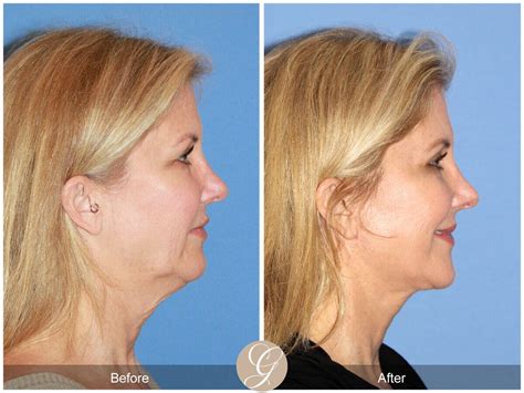 Neck Lift Before And After Photos Patient 103 Dr Kevin Sadati