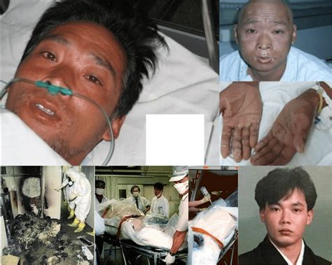 Hisashi Ouchi Was Kept Alive For 83 Days After Absorbing 17 Sieverts Of